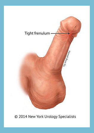 Penis frenectomy hamilton